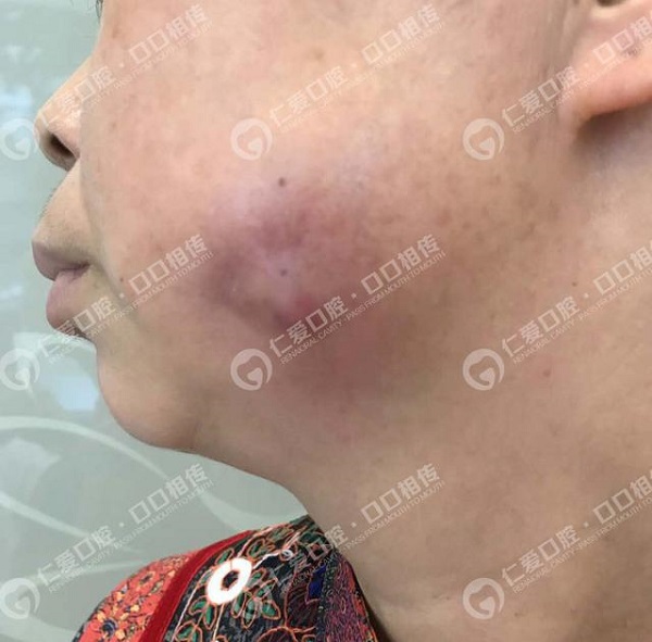驚!女子智齒反復發炎未在意,臉頰被膿腫穿破
