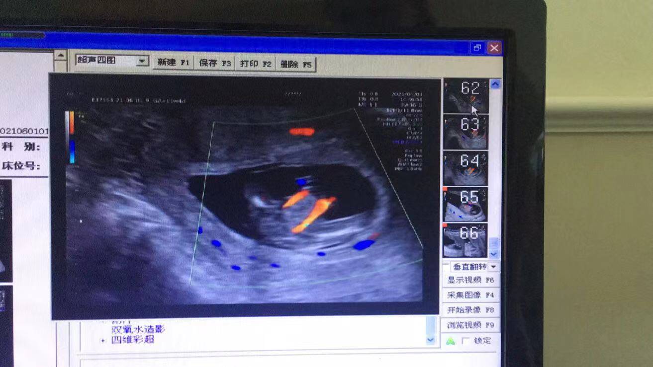 NT篩查出胎兒多發畸形，準媽媽無奈終止妊娠